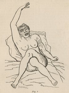 Hysteerinen epilepsia, kohtaus, vääntymät, kuva. 1 teoksesta "Iconographie Photographique de La Salpetriere", Bourneville et P. Regnard, Pariisi, 1876