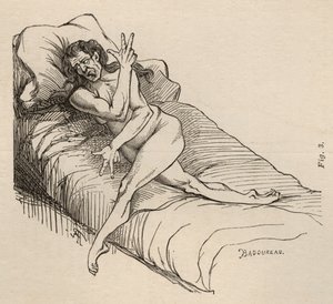Hysteerinen epilepsia, kohtaus, vääntymät, kuva. 3 teoksesta "Iconographie Photographique de La Salpetriere", Bourneville et P. Regnard, Pariisi, 1876 tekijältä Jean Francois Badoureau