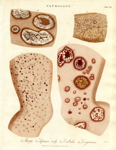 Patologiset ihosairaudet: Pallada ja impetigo. tekijältä John Pass