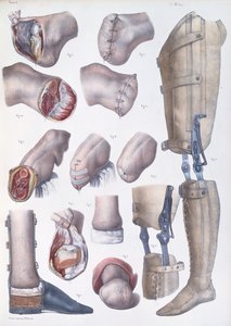 Amputaatiot ja proteesit, levy Jean-Baptiste Marc Bourgeryn (1797-1849) "Traite Complet de l