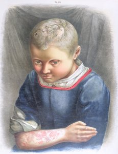 Favus, Daniel Cornelius Danielssenin (1815-94) kirjasta 1892 tekijältä Norwegian School