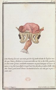 Poikkileikkauskaavio vauvasta, joka on vedetty kohdusta käsivarresta, J. Robertin kaivertamasta Madame Angelique Le Boursier du Coudrayn (1714-94) kirjasta, 1783 tekijältä P. Chapparre