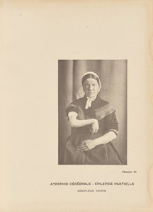 Aivojen surkastuminen: Hemiplegia oikealla. tekijältä Paul Marie Léon Regnard