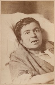 Hysteerinen epilepsia, kasvojen supistuminen, levy VIII Bournevillen ja P. Regnardin teoksesta "Iconographie Photographique de La Salpetriere", Pariisi, 1876 (albumiprintti) tekijältä Paul Regnard