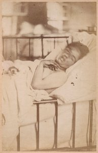 Hysteerinen epilepsia, pysyvä supistuminen, levy XXVIII Bournevillen ja P. Regnardin teoksesta "Iconographie Photographique de La Salpetriere", Pariisi, 1876 (albumiprintti)