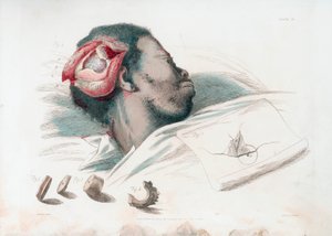 Näkymä kallon haavasta trefinaation ja särkyneen luukappaleen poistamisen jälkeen alhaalla vasemmalla, 1821 tekijältä Thomas Landseer