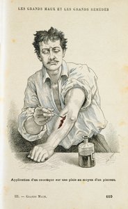 Haavan maalaus antiseptisellä liuoksella, c1890 tekijältä Unbekannt