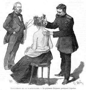 Professori Bergmann ruiskeena tuberkuloosipotilaalle, 1891 tekijältä Unbekannt