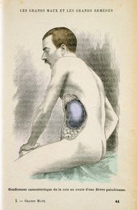 Tyypillinen suurentunut perna malariapotilaalle, c1890 tekijältä Unbekannt