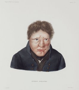 Sairaudet, Lepra Mies spitaalinen, Islanti, 1800-luvun alku tekijältä Unbekannt