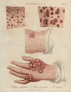 Ihohaavauma, märkivä syyhy ja syyhy, jonka aiheuttaa scabiei-sarkoptinen punkki - John Passin litografia, julkaistu John Wilkesin "Encyclopedia Londinensis" -teoksessa, J.Adlardin painos, Lontoo. tekijältä Unbekannter Künstler