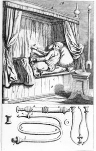 Clystère (peräruiskeille), kirjoittanut Johannes Sculptetus "" Armamentarium Surgical"". Venetsia 1665 tekijältä Unknown artist