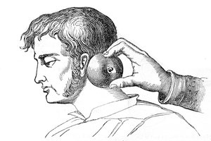 Saignee locales - iilimatojen levitys omenalla - kaiverrus "La Santo Universelle - Medical Guide for Families" 1852 tekijältä Unknown artist