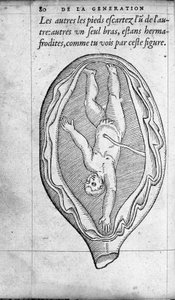 Sikiön sijainti kohdussa raskauden aikana. Kaiverrus ranskalaisen lääkärin ja kirurgin Ambroise Paren (1509-1590) teoksesta "De la Generation des enfants" 1500-luku tekijältä Unknown artist