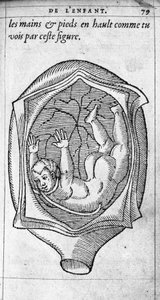 Sikiön asema kohdussa raskauden aikana. Kaiverrus ranskalaisen lääkärin ja kirurgin Ambroise Paren (1509-1590) teoksesta "De la Generation des enfants" 1500-luku tekijältä Unknown artist
