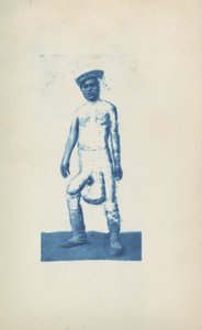 Elefantiasis,c. 1870-luku (kuva) tekijältä Unknown photographer