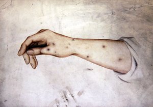 Tutkimus kyynärvarresta, jossa on ihon kunto, n. 1850 (akvarelli paperille) tekijältä William Lover