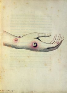Lehmänrokko märkärakkula Sarah Nelmesin käsivarressa, Pearcen kaivertamasta Edward Jennerin (1749-1823) teoksesta An Inquiry to the Causes and Effects of the Variolae Vaccinae, n. 1800