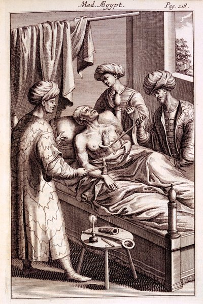 Prospero Alpinuksen kuva moksibustiosta Medicina Aegyptorumista, 1745 tekijältä American School