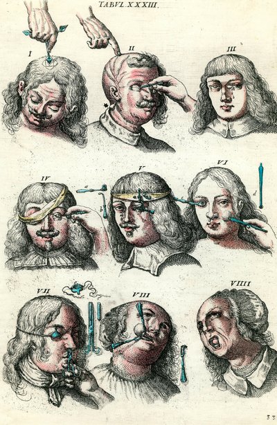 Kirurgia 1700-luvulla: silmän ja kasvojen trepanaatio ja leikkaus. Kaiverrus Lorenz Heisterin kirjaan "Institutions chirurgicale". tekijältä Anonymous Anonymous
