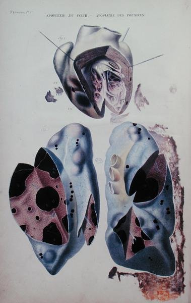 Sydämen ja keuhkojen apopleksia, kuvalevy Jean Cruveilhierin (1791-1874) Anatomie pathologique du corps humainista, julkaistu Pariisissa tekijältä Antoine Chazal