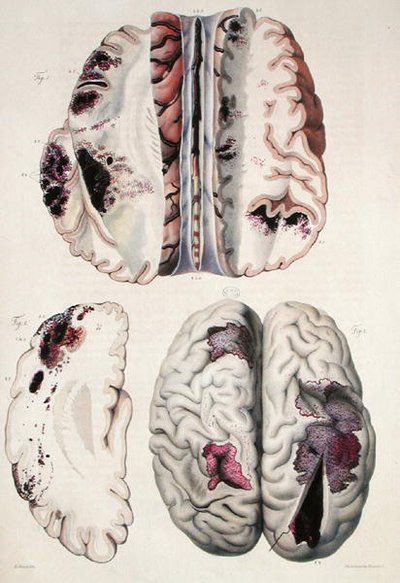 Kapillaarinen apopleksia, Jean Cruveilhierin (1791-1874) teoksesta "Anatomie Pathologique du Corps Humain" 1828-42 (värinen kaiverrus) tekijältä Antoine Chazal
