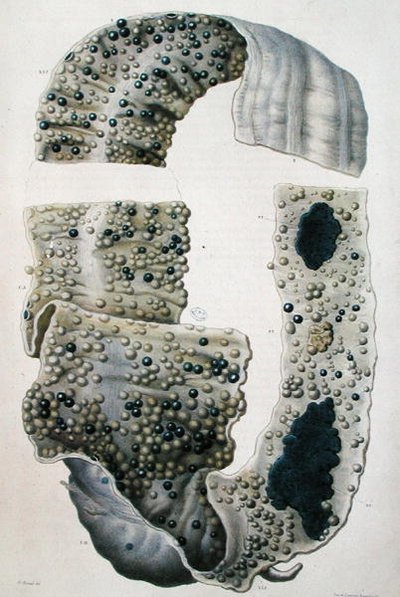 Suolisairaudet, Jean Cruveilhierin (1791-1874) julkaisusta "Anatomie Pathologique du Corps Humain", 1828-42 (värinen kaiverrus) tekijältä Antoine Chazal