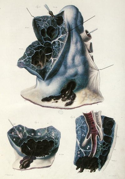 Keuhkosairaudet, Jean Cruveilhierin (1791-1874) 1828-42 julkaisusta Anatomie Pathologique du Corps Humain (värillinen kaiverrus) tekijältä Antoine Chazal