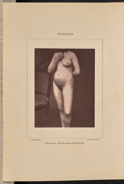 Yleistynyt vesikulaarinen kuppa tekijältä Arthur de Montmeja