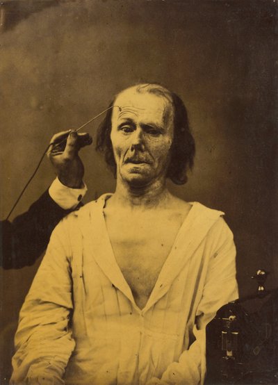 Rentoutuneet kasvot vasemmalla, syvällinen huomio oikealla, 1854-1856, painettu 1862. tekijältä Duchenne de Boulogne