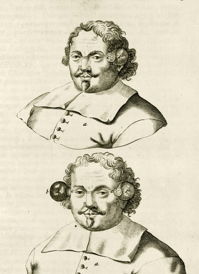 Esimerkki kuppauksesta, Frederik Dekkerin teoksesta The Practice of Medicine, 1694 tekijältä Dutch School