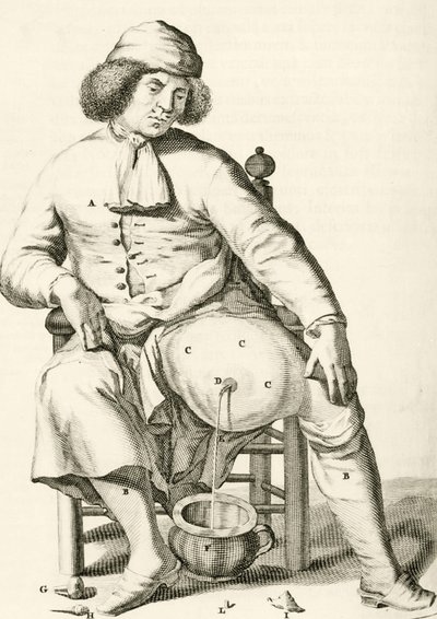 Frederik Dekkers, 1694, nesteen tyhjennys paiseesta tekijältä Dutch School