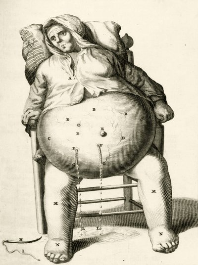 Nesteiden tyhjennys paiseesta, Frederik Dekkers, 1694 tekijältä Dutch School