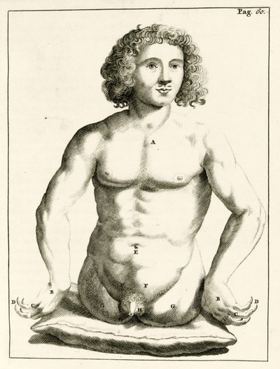 Frederik Dekkers, 1694, esimerkki synnynnäisistä epämuodostumista tekijältä Dutch School
