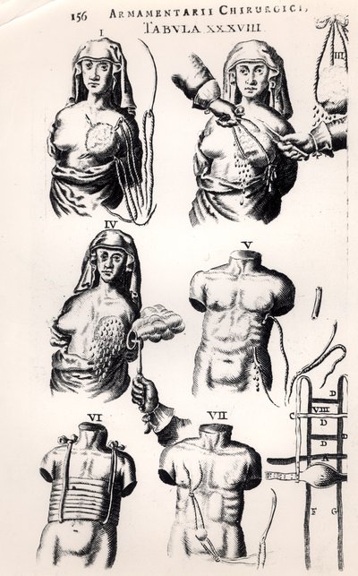 Rintasyövän leikkaus, Johannes Schultesin (1595-1645) Armamentarii Chirurgici, julkaistu Amsterdamissa, 1672 tekijältä Dutch School
