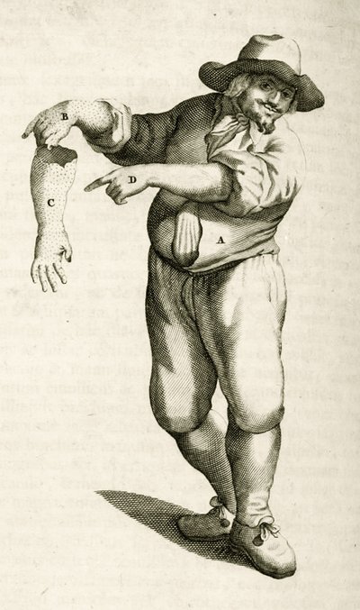 Kuolleen ihon poistaminen märkärakkuloilla, Frederik Dekkersin käytännön harjoituksista lääketieteellisissä menetelmissä, 1694 tekijältä Dutch School