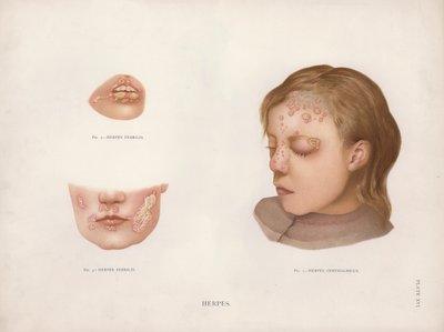 Ihosairaudet: Herpes (väri litho) tekijältä English School