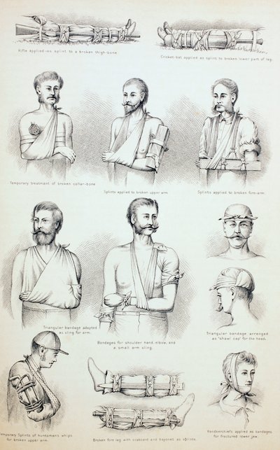 Murtumien väliaikainen hoito, n. 1890 tekijältä English School