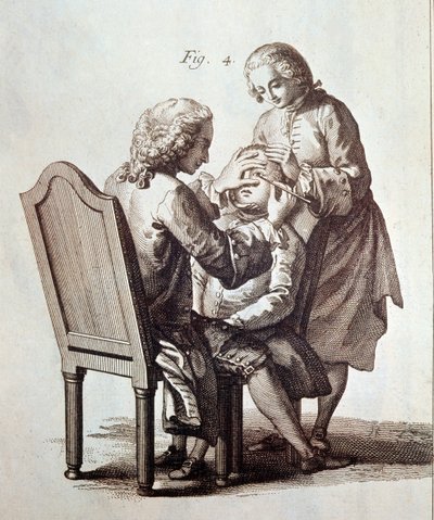 Lääkäri leikkaa kaihipotilasta, kuva Denis Diderot