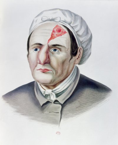Ihonsiirtoleikkauksen jälkeen, Alexander Auvertin Selecta Praxis Medico-Chirurgica, Pariisi, 1856 tekijältä French School