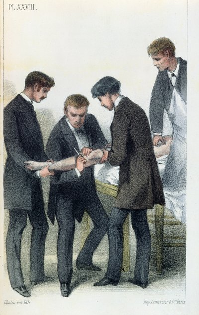 Käden amputointi Jean-Baptiste-Leon Dubreuilin lääketieteellisestä käsikirjasta, n. 1850-60 tekijältä French School