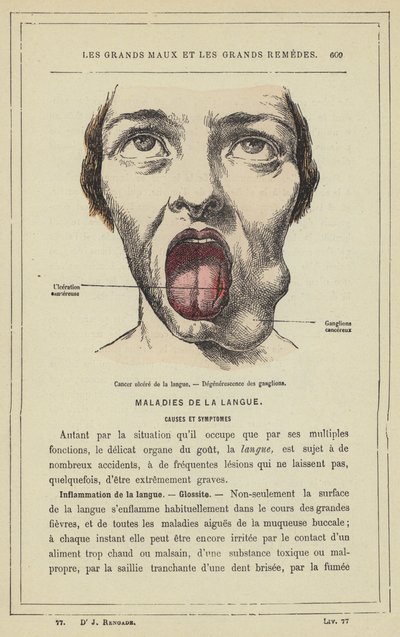 Kielen haavasyöpä, imusolmukkeiden rappeuma (väri litho) tekijältä French School