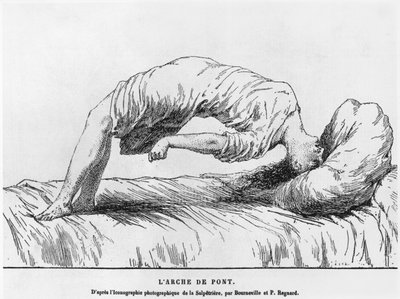 Hysteria ja somnambulismi, Paul Regnardin (1850-1927) Les Maladies Epidemiques de lEsprit -teoksesta 1884 tekijältä French School