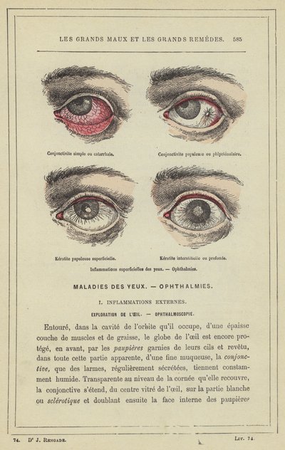 Pinnalliset silmätulehdukset, Oftalmia (väri litho) tekijältä French School