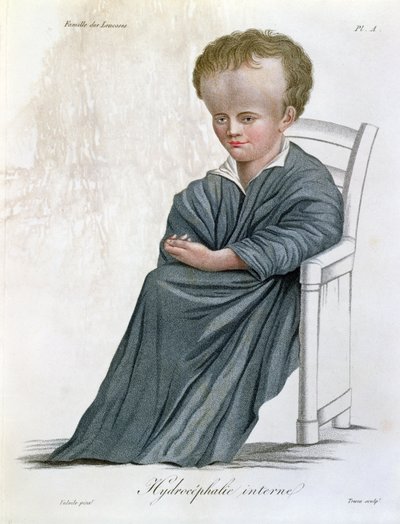 Sisäinen vesipää, Nosologie Naturelle, Baron Jean Louis Alibert (1768-1837), kaiverrus Tresca, 1817 tekijältä French School