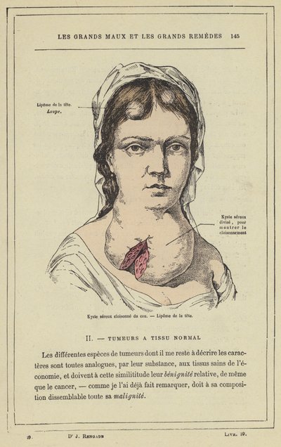 Cloisonnen seroosikysta kaulassa, pään lipoma (väri litho) tekijältä French School