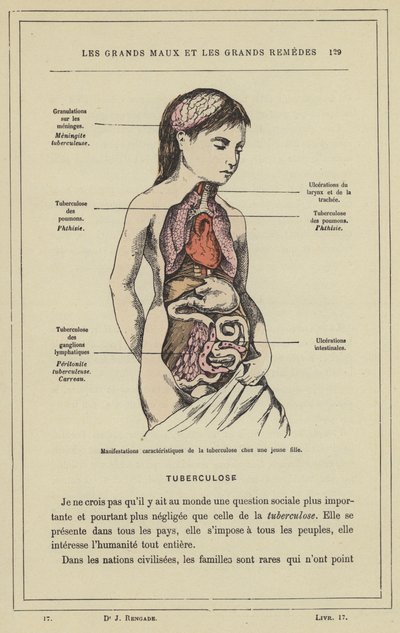 Tuberkuloosin tyypillisiä ilmenemismuotoja nuorella tytöllä (väri litho) tekijältä French School