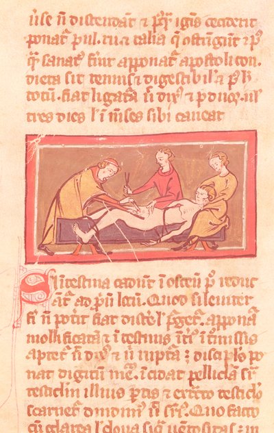 Ms H 89 fol.23 Surgery, Rogier de Salernen kirjan Book of Surgery painoksesta tekijältä French School