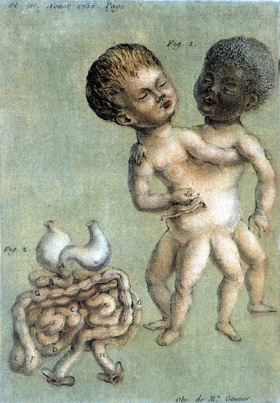 Siamilaisia ​​veljiä edustava lääkelevy: valkoinen ja musta. Toussaintin (1756) kuvitus teoksessa "Periodic Observations on Physics, Natural History and the Arts". tekijältä French School