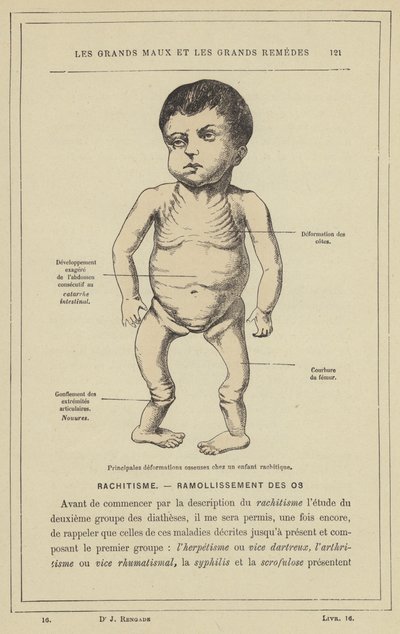 Tärkeimmät luun muodonmuutokset riisitautilapsella (väri litho) tekijältä French School